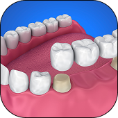 Dental Bridges
