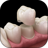 Dental Crowns