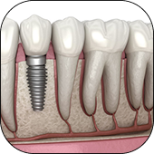 Dental Implants