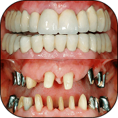 Full Mouth Restoration
