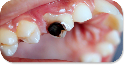 High cavity risk